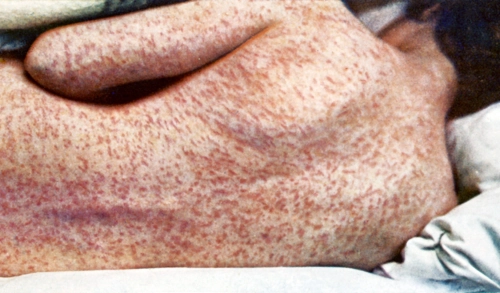 School district bracing for measles